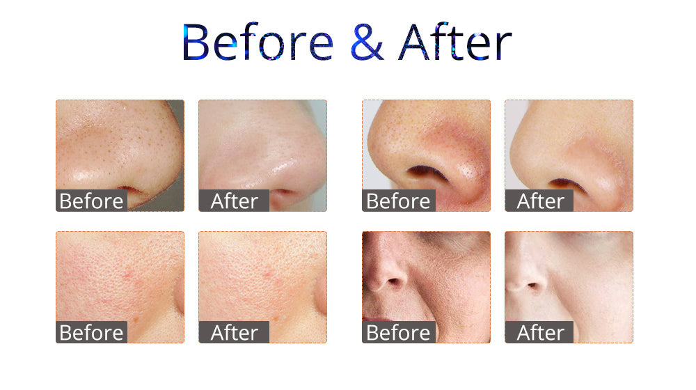 Peneelily Pro Hydra Facial Ultrasonic Bio Skin Scrubber Hot Cold Care Beauty Spa - Suerbeaty
