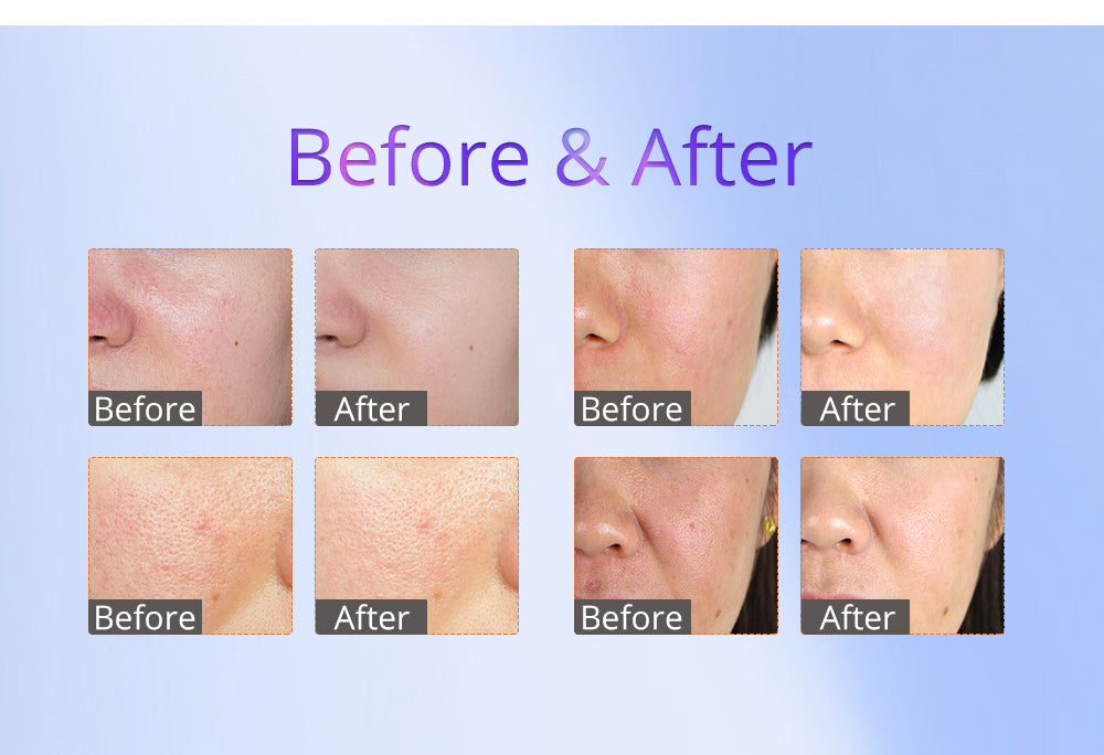 7In1 3D Radio Frequency Skin Tightening BIO Hot&Cold Hammer Skin Care Skin Scrubber Machine - Suerbeaty