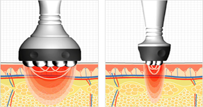 Ultrasonic Cavitation and Localized Fat Removal - Suerbeaty