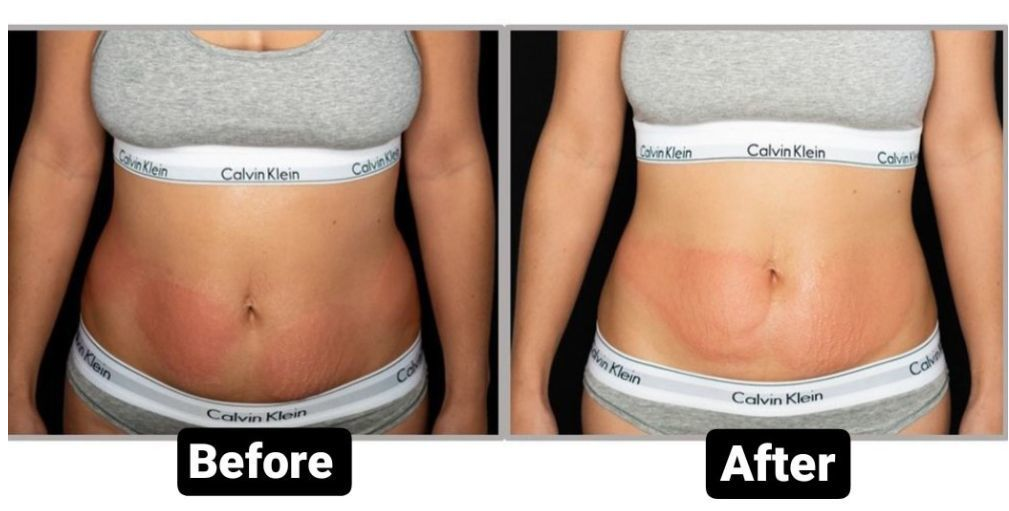 Start Your Fat Freezing Treatment and Get Ready for This Summer! - Suerbeaty