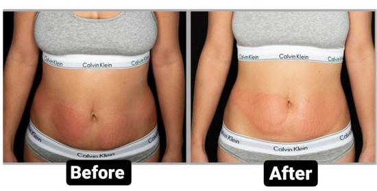 Start Your Fat Freezing Treatment and Get Ready for This Summer! - Suerbeaty