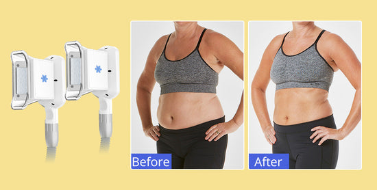 Does Fat Freezing Work & How Many Fat Freezing Sessions are Recommended? - Suerbeaty